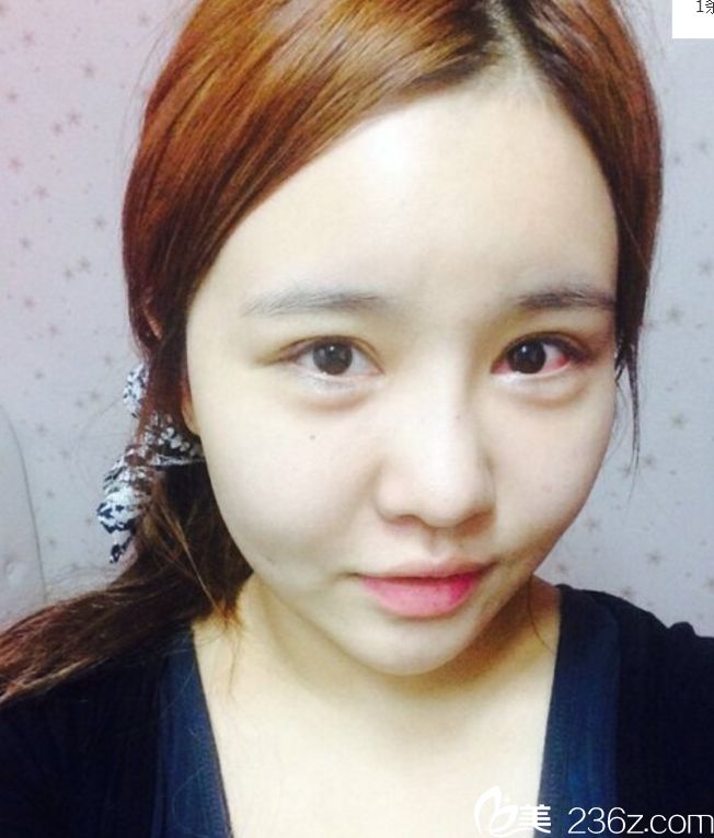 柳元敏双眼皮修复真人案例 柳元敏双眼皮修复真人案例