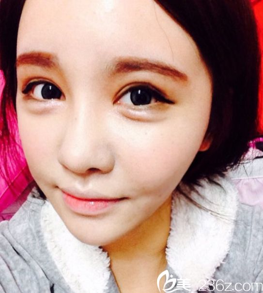 韩国美佳整形美容医院柳元敏院长双眼皮修复真人案例