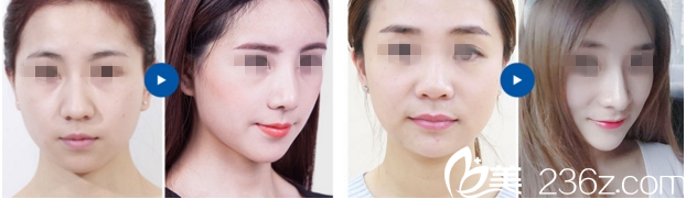 重庆华美整形张国强隆鼻案例 重庆华美整形张国强隆鼻案例