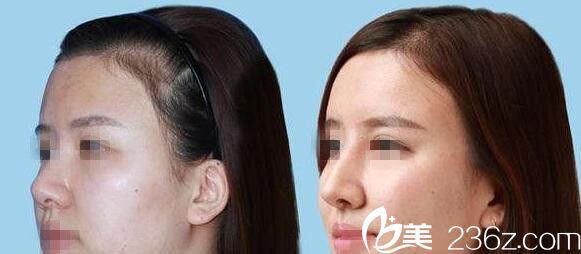 韩国美丽世界整形外科真人案例 韩国美丽世界整形外科真人案例