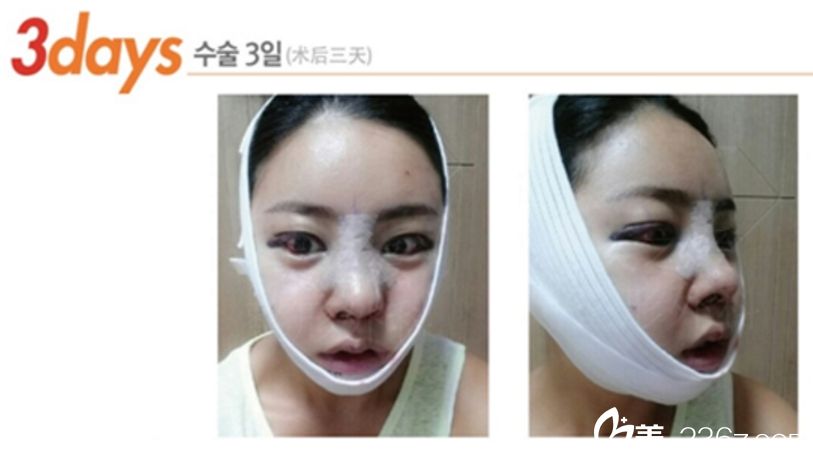 沈炯坤院长颧骨+V-line手术真人案例 沈炯坤院长颧骨+V-line手术真人案例