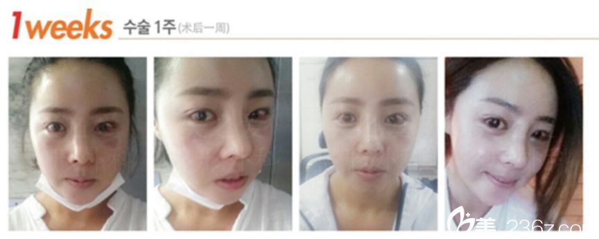 美之爱沈炯坤鼻整形 双眼皮真人案例 美之爱沈炯坤鼻整形 双眼皮真人案例