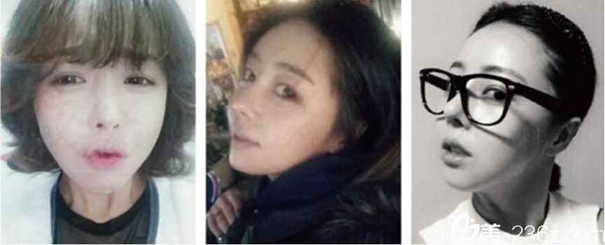 美之爱整形外科沈炯坤院长技术怎么样?颧骨+V-line手术+鼻修复+开眼角提肌真人案例 美之爱整形外科沈炯坤院长技术怎么样?颧骨+V-line手术+鼻修复+开眼角提肌真人案例