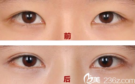 王焕切开双眼皮案例图 王焕切开双眼皮案例图