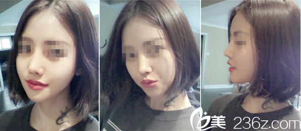 分享我在A特整形中心做鼻+面部轮廓整形过程，金汉祚院长案例