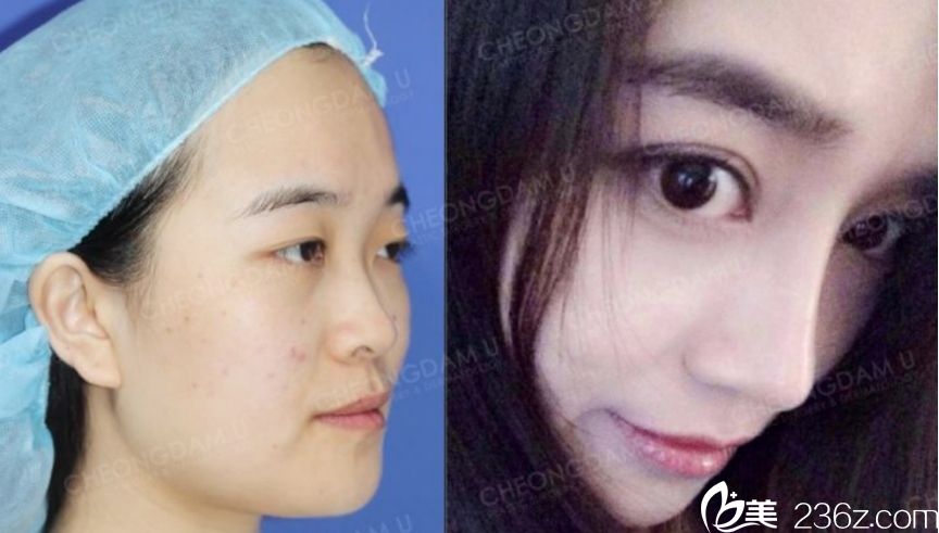 真人案例对比 韩国清潭优整形外科隆鼻 真人案例对比 韩国清潭优整形外科隆鼻