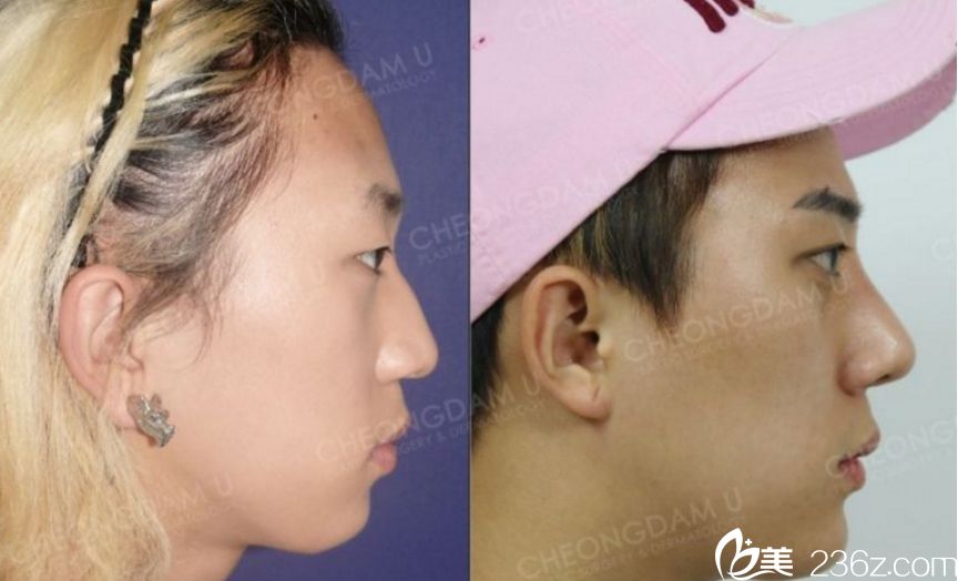 韩国清潭优整形外科做鼻子出名吗 韩国清潭优整形外科做鼻子出名吗