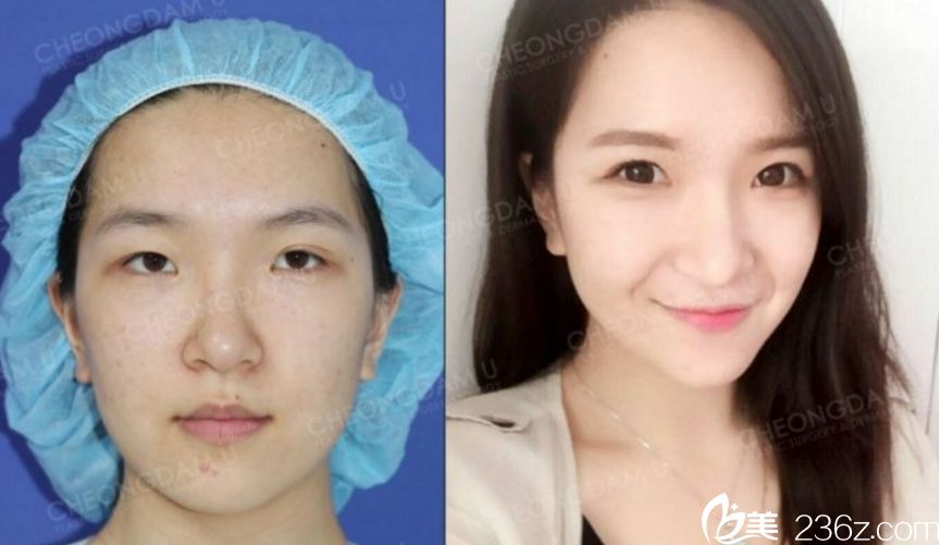 韩国清潭优整形外科金虎吉 做鼻子出名吗 韩国清潭优整形外科金虎吉 做鼻子出名吗