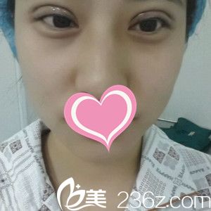 刚做完双眼皮手术的样子 刚做完双眼皮手术的样子