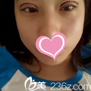 双眼皮术后3天眼睛依然肿胀 双眼皮术后3天眼睛依然肿胀
