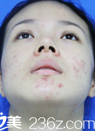 鼻综合术前 鼻综合术前