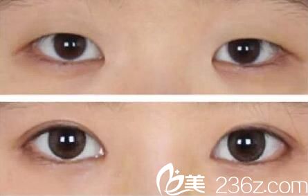 韩国绮林整形外科开内眼角案例 韩国绮林整形外科开内眼角案例