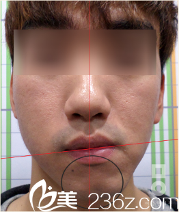 韩国美尔韩整形医院颜面不对称真人矫正前 韩国美尔韩整形医院颜面不对称真人矫正前