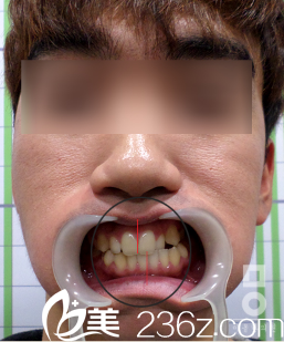 美尔韩真人面部不对称矫正前牙齿状况