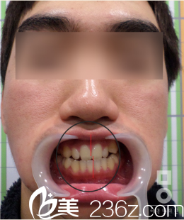 韩国美尔(miall)韩整形医院面部不对称矫正真人<span style= 韩国美尔(miall)韩整形医院面部不对称矫正真人<span style=