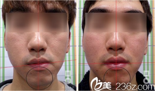 美尔韩整形医院真人治疗前后对比 美尔韩整形医院真人治疗前后对比