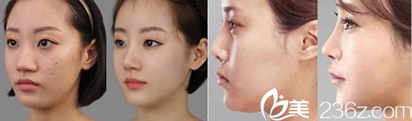 <!--<i data=20240703-sp></i>-->鼻综合隆鼻案例图