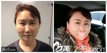 桂林华美医疗美容整形医院甘学文案例