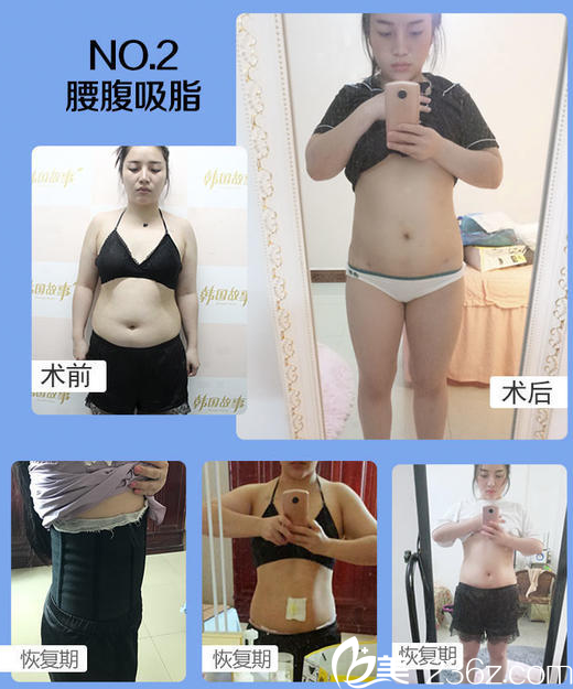 南宁韩成(韩国)故事整形医院李宁腰腹吸脂案例 南宁韩成(韩国)故事整形医院李宁腰腹吸脂案例