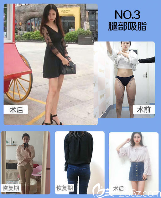 南宁韩成(韩国)故事整形医院李宁大腿抽脂案例 南宁韩成(韩国)故事整形医院李宁大腿抽脂案例