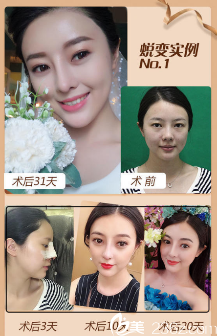 南宁韩成(韩国)故事整形医院李宁鼻综合隆鼻案例 南宁韩成(韩国)故事整形医院李宁鼻综合隆鼻案例