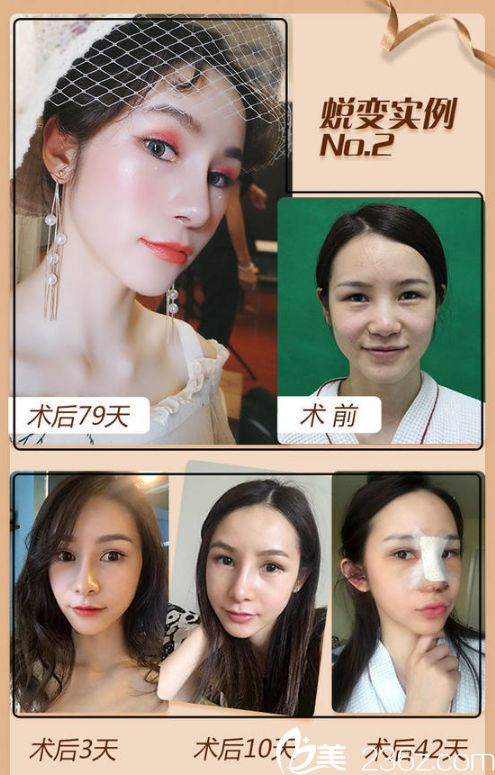 南宁韩成(韩国)故事医疗整形美容医院高静隆鼻案例对比图 南宁韩成(韩国)故事医疗整形美容医院高静隆鼻案例对比图