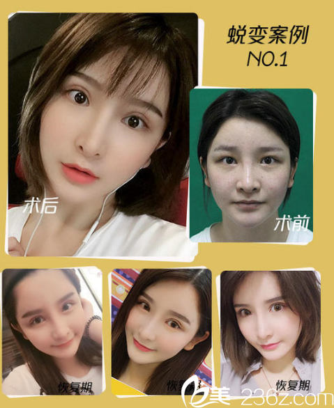 南宁韩成(韩国)故事医疗整形美容医院高静做的双眼皮案例 南宁韩成(韩国)故事医疗整形美容医院高静做的双眼皮案例