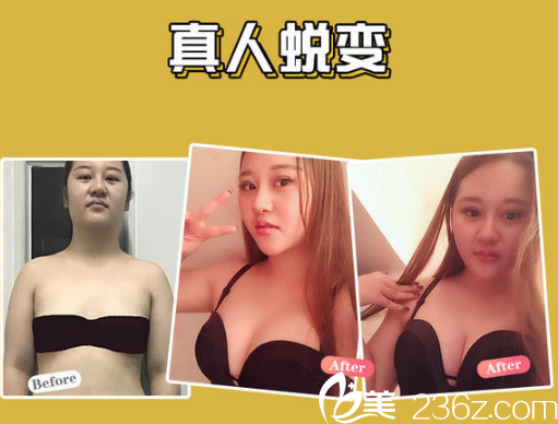 南宁韩成（韩国）故事医疗整形美容医院高静做的自体脂肪隆胸案例