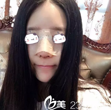 鼻综合案例术后1周重庆美仑美奂 鼻综合案例术后1周重庆美仑美奂