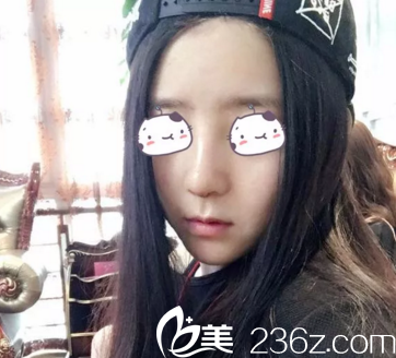 术后15天效果图鼻综合案例重庆美仑美奂 术后15天效果图鼻综合案例重庆美仑美奂