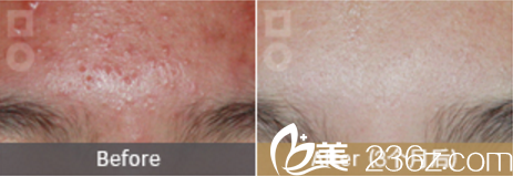 美尔韩祛除青春痘<span style= 美尔韩祛除青春痘<span style=