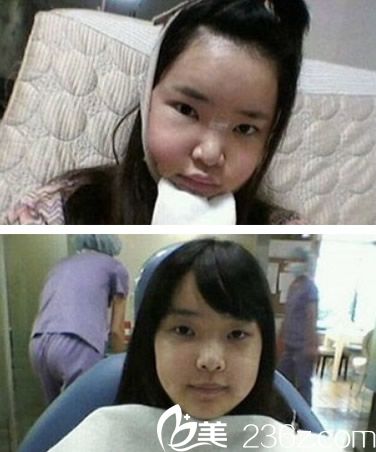 欧菲自体脂肪填充术前准备 欧菲自体脂肪填充术前准备