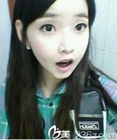 我在泉州欧菲找王伟韬做自体脂肪填充下巴效果好吗？