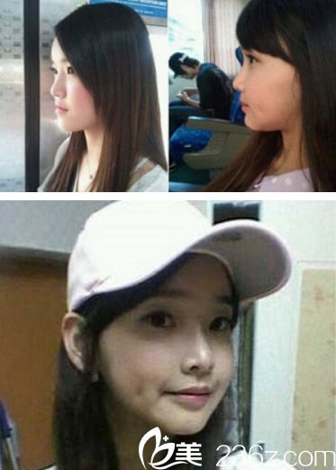 欧菲王主任填充下巴效果对比