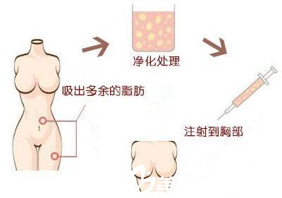 麦恩医院自体脂肪丰胸脂肪提取过程