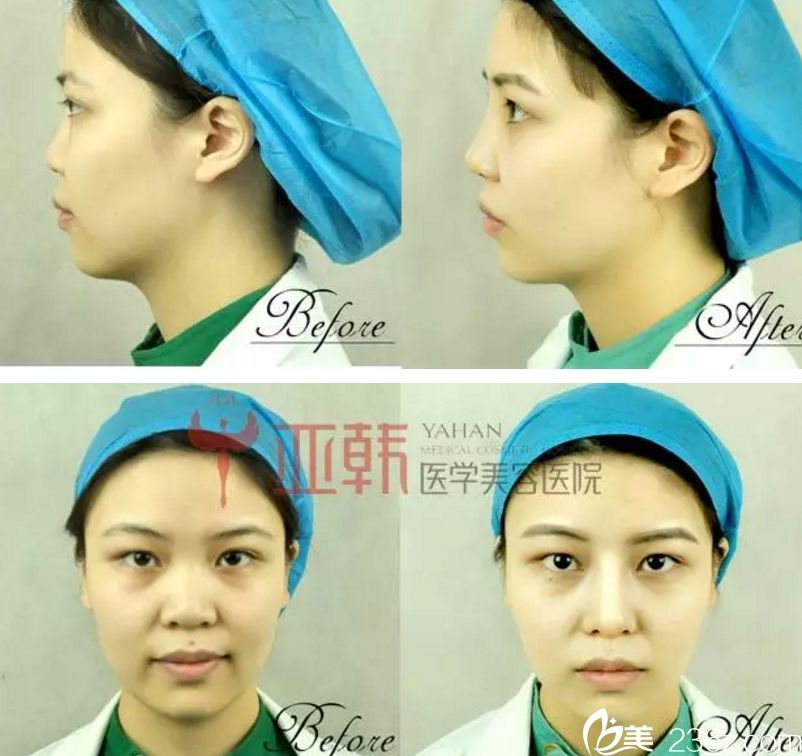 长沙鼻整形医生吴蒙真人案例 长沙鼻整形医生吴蒙真人案例