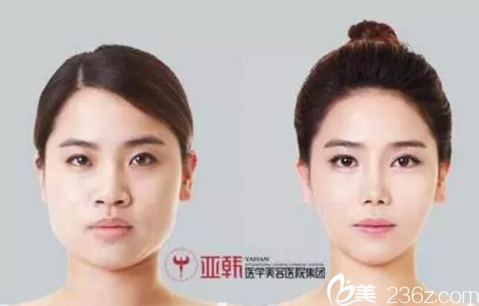 长沙亚韩赵贵庆打造的案例 隆鼻双眼皮