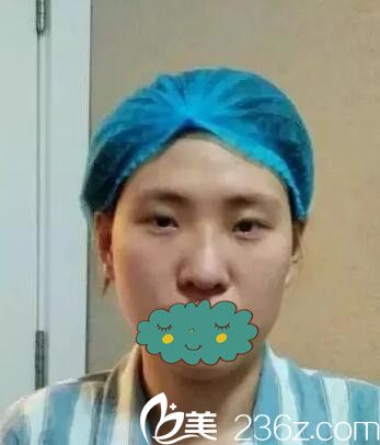 眼综合加鼻综合术前 眼综合加鼻综合术前