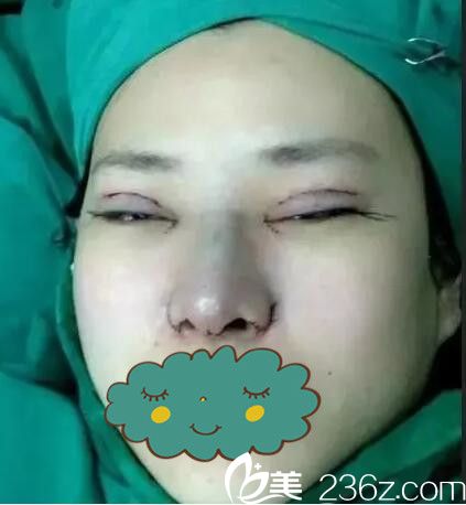 海南梦妮幻眼鼻整形术后即刻 海南梦妮幻眼鼻整形术后即刻