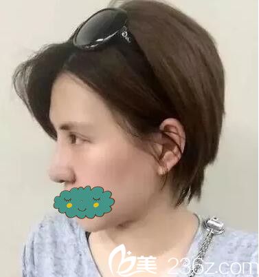 术后一周眼鼻整形拆线侧颜效果 术后一周眼鼻整形拆线侧颜效果