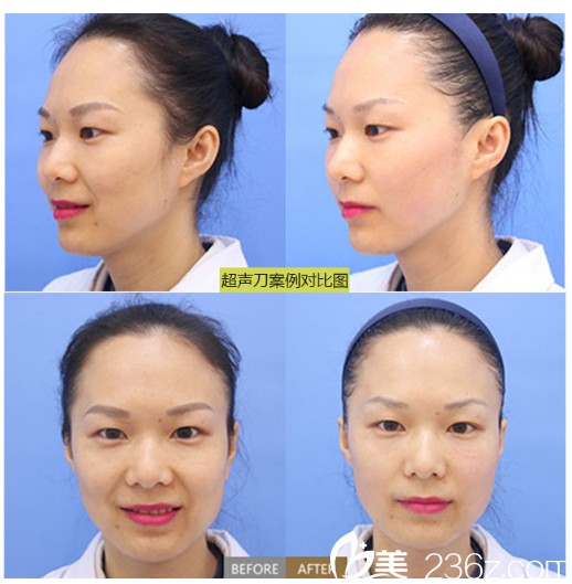 柳州华美整形医院刘文先真人案例