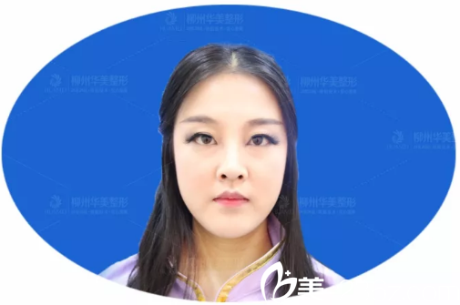 朝天鼻修复术前照片 朝天鼻修复术前照片