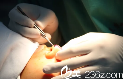 王文院长开始对鼻部进行设计 王文院长开始对鼻部进行设计