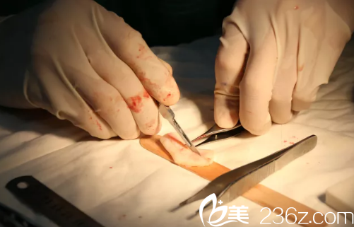 雕刻肋软骨 雕刻肋软骨