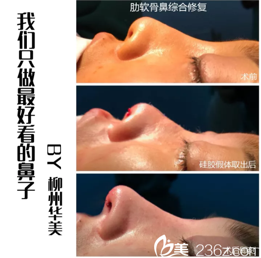 柳州华美隆鼻怎么样？王文院长肋软骨鼻综合修复案例过程大起底