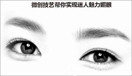 郑州韩式双眼皮手术