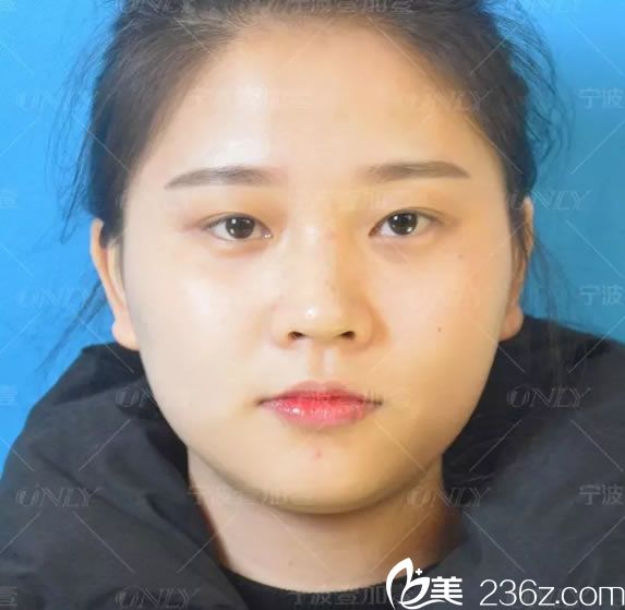 做双眼皮和隆鼻前的小白 做双眼皮和隆鼻前的小白