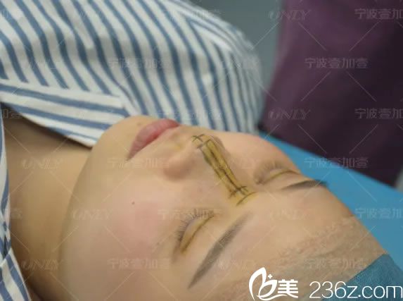 医生给小白设计的眼鼻手术方案 医生给小白设计的眼鼻手术方案