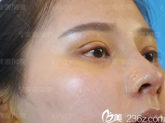 做完鼻综合7天拆线的<span style= 做完鼻综合7天拆线的<span style=