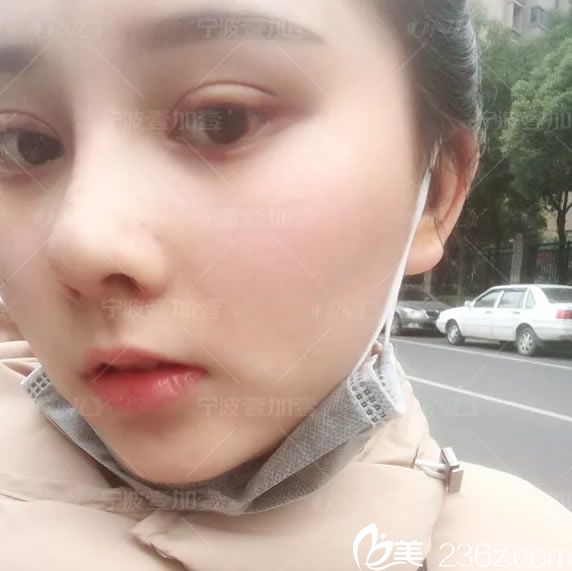 宁波壹加壹护士做双眼皮和隆鼻15天<span style= 宁波壹加壹护士做双眼皮和隆鼻15天<span style=